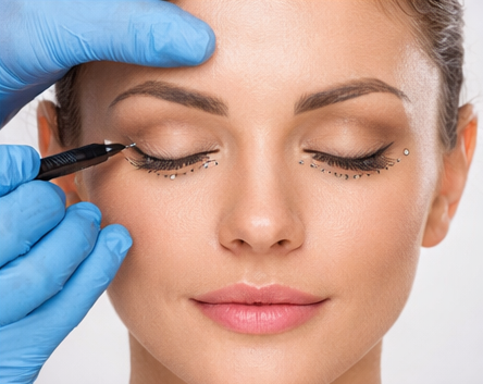 Блефаропластика